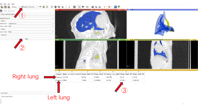 figure-protocol-9 CT scan segmentation; lung volume analysis; 3D Slicer interface; medical imaging process.