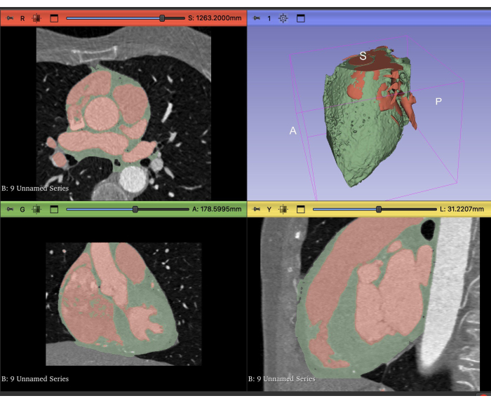 figure-results-1 CT heart scan; 3D model and cross-sectional images. Cardiac structure visualization, anatomy study.