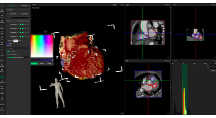 figure-results-7 Cardiac CT analysis, 3D heart visualization, anatomical study, data quantification diagram.