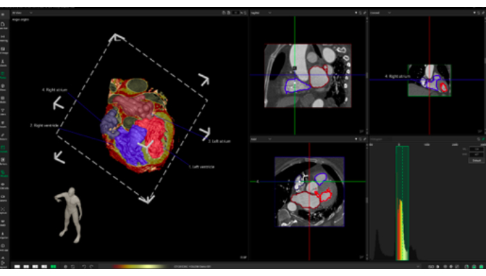 figure-results-8 3D heart imaging analysis, annotated diagrams; CT scan; cardiac structure visualization.