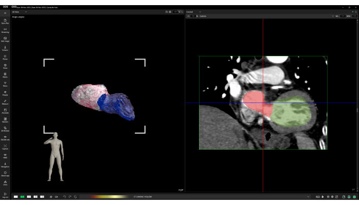 figure-results-11 CT imaging analysis, 3D model and cross-section, cardiovascular focus, diagnostic visualization.