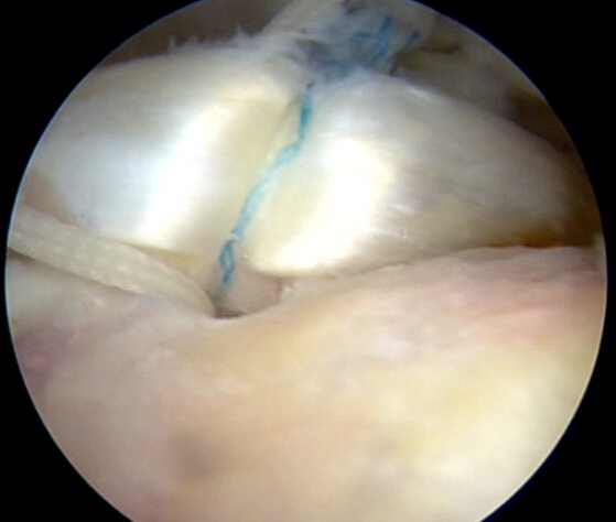 figure-results-1 Arthroscopic view, orthopedic surgery procedure, highlighting sutured tissue and repair technique.