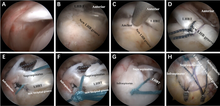 figure-results-4 Shoulder arthroscopy process showing tendon fixation and groove formation in surgical diagrams.