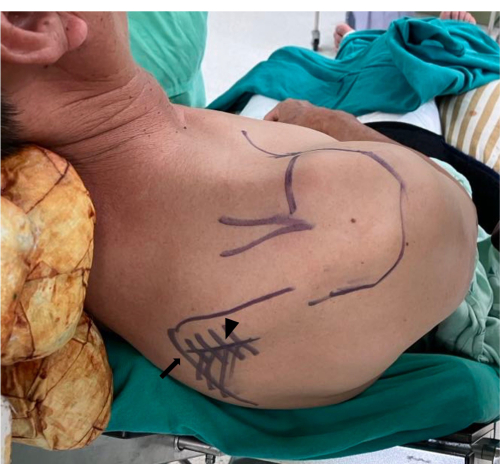 Surgical planning drawn on shoulder; lines indicating incision and anatomical landmarks.