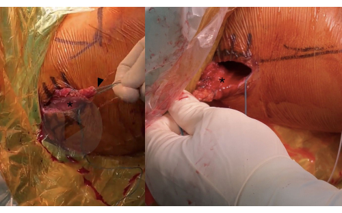 Surgical procedure diagram; highlighting soft tissue incision and retraction for orthopedic analysis.