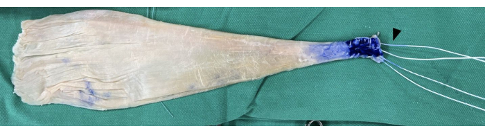 Surgical retractor method, dyed tissue with sutures, surgical procedure demonstration.