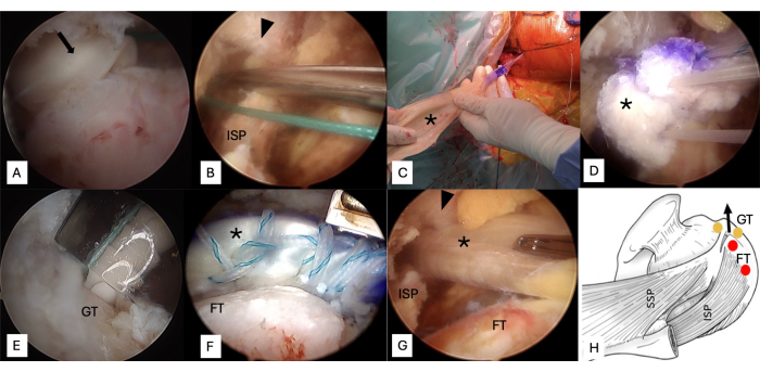 Arthroscopic shoulder surgery steps, diagram; tendon repair; surgical tools; procedural illustration.