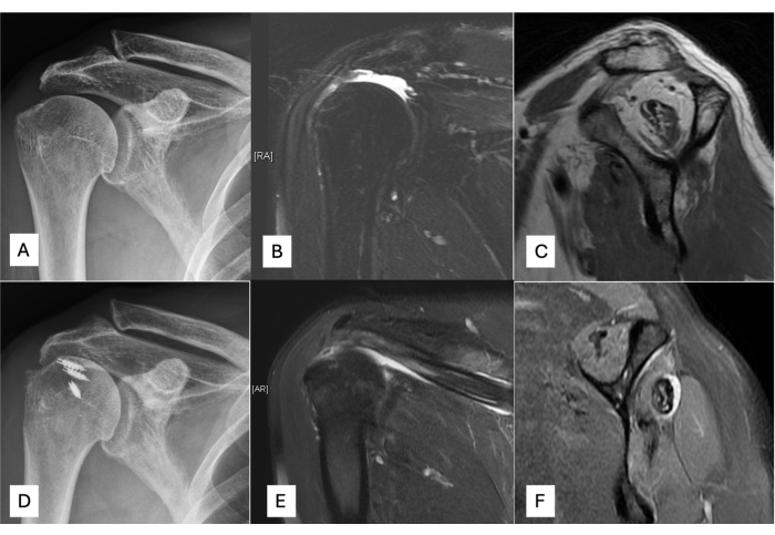Shoulder joint MRI and X-ray comparison, imaging for rotator cuff assessment and bone structure analysis.