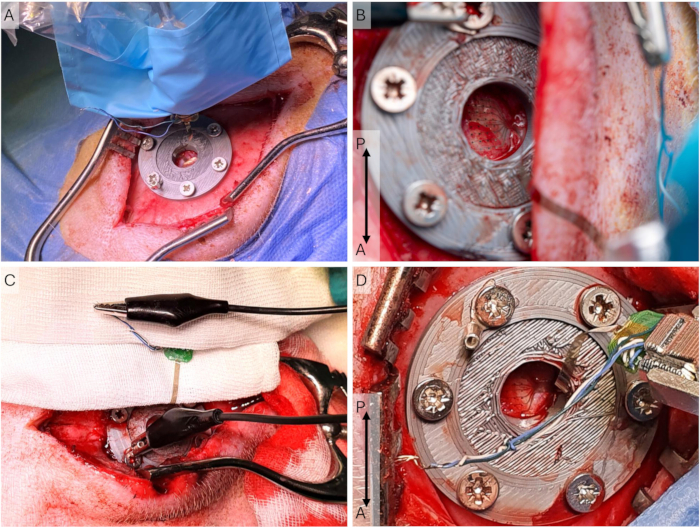 Surgical implant procedure with electrode connections; device insertion and fixation process.