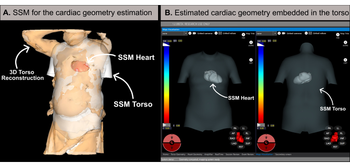 3D torso reconstruction and SSM heart in diagram for cardiac geometry estimation and embedding.