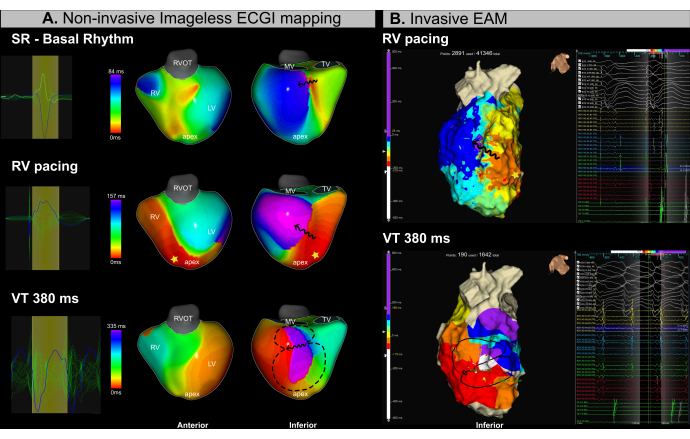 ECGI vs EAM mapping diagram; cardiac arrhythmia analysis using pacing signals and 3D models.