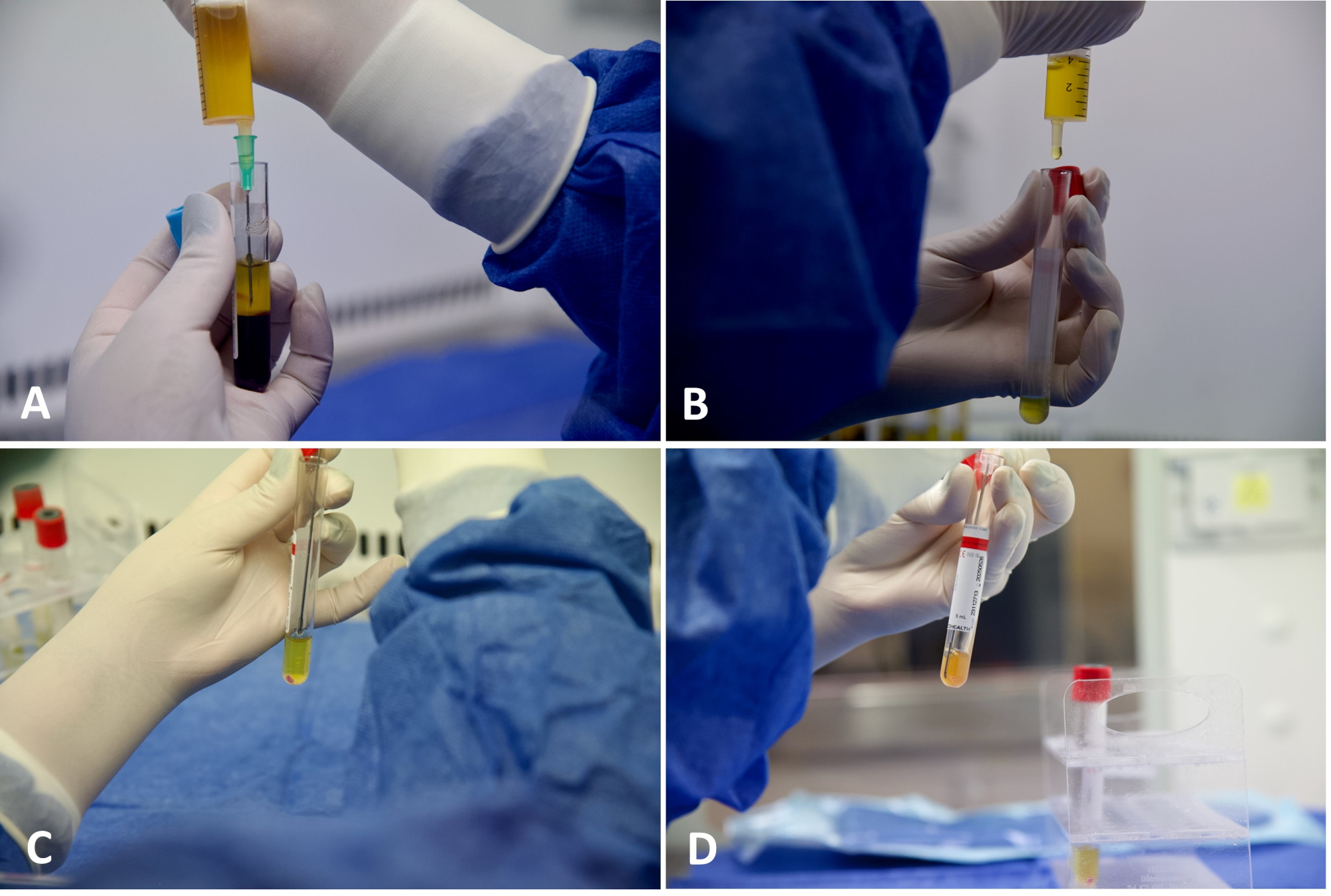 Tube Method Mix Field A Simple Double Centrifugation Tube Method to Obtain Platelet-rich ...