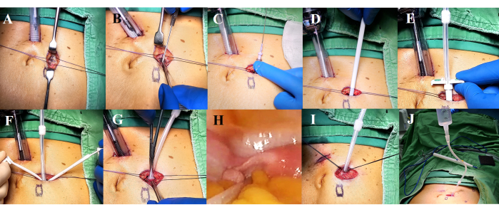 Laparoscopic surgery process diagram; steps with trocars, sutures, and tissue manipulation visuals.