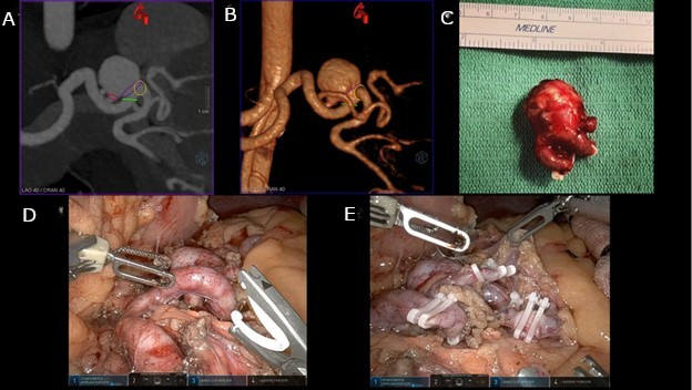 CT angiography and surgical procedure showing aneurysm detection and removal steps.