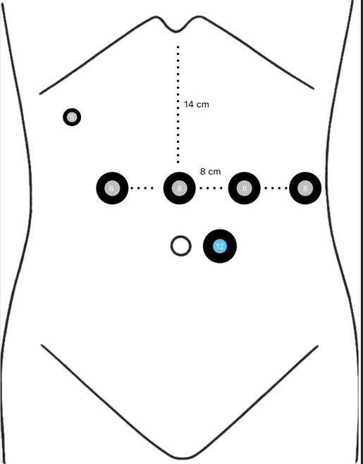 Electrode placement diagram for ECG, detailing positions and distances on the human torso.