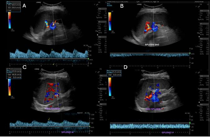Color Doppler ultrasound of spleen with velocity profiles, displaying blood flow dynamics in spleenic vessels.