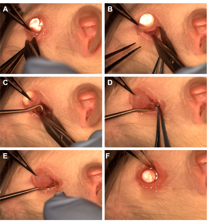 Surgical ear procedure sequence, six steps, illustrating removal technique, medical tools in use.