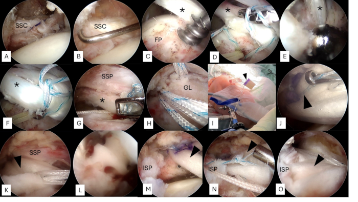 Arthroscopic rotator cuff repair, surgical procedure steps, visual guide, medical technique.