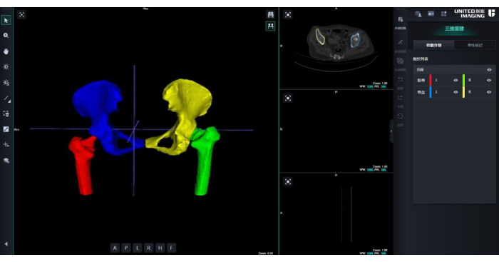 3D bone structure analysis, medical imaging software interface, anatomical modeling, visualization tool.