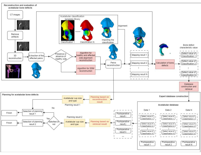 Acetabular bone defect reconstruction process flowchart; CT imaging to database retrieval.
