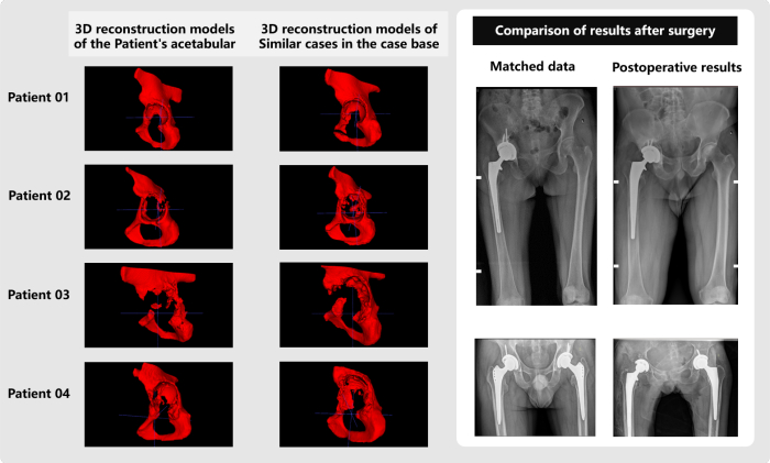 3D reconstruction acetabular models, pre- and postoperative X-ray comparison, surgical outcome analysis.