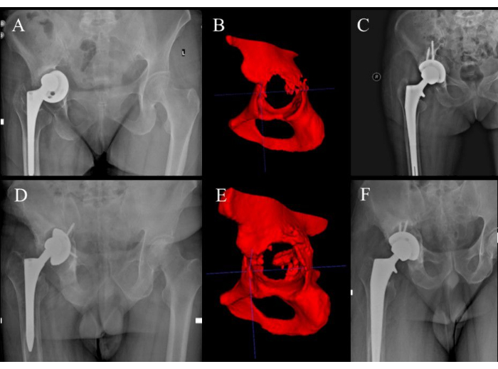 Hip replacement imaging; x-ray, 3D scan, bone structure analysis; medical diagnostic study.