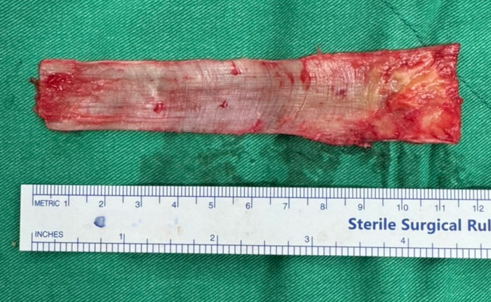 Harvested human tendon specimen with surgical ruler; anatomy analysis, tissue length measurement.