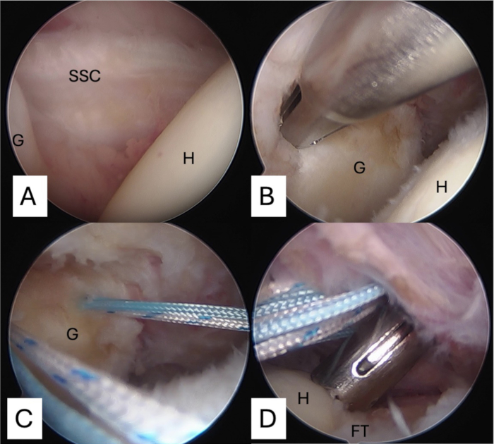 Arthroscopic surgery sequence, illustrating suture repair of joint tissues, medical procedure visual.