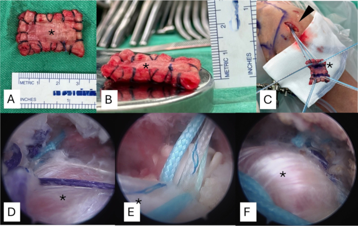 Surgical graft preparation and arthroscopic procedure for tendon repair, showing measurement and stitching.