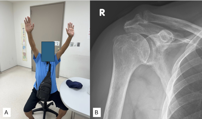 Shoulder mobility assessment and X-ray; diagnosing range of motion and skeletal alignment.