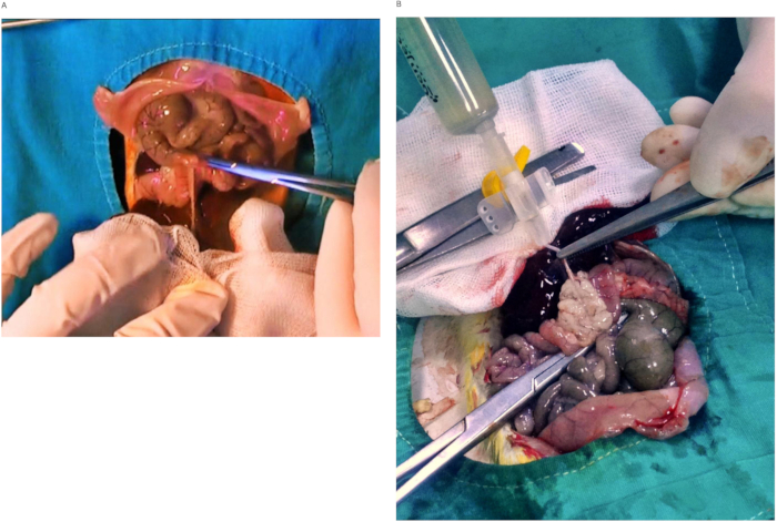 figure-protocol-1 Surgical procedure, abdominal cavity, surgical tools in use, tissue examination, medical technique.