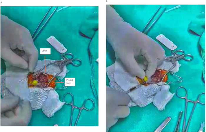 figure-protocol-3 Liver surgery process; portal vein exposure; surgical tools; anatomy study; medical procedure.