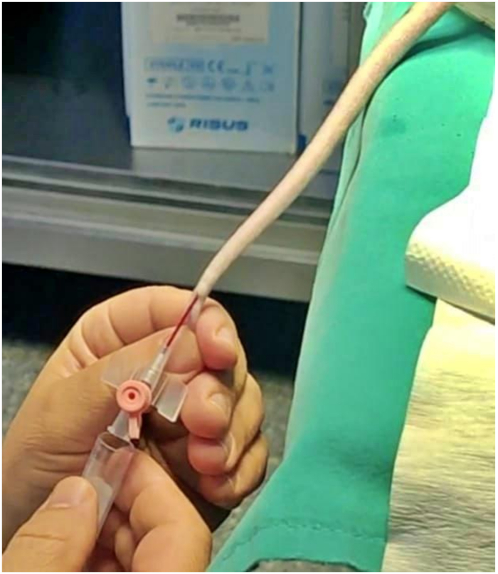 figure-protocol-4 Blood collection process with needle and tube; phlebotomy technique; medical procedure setup.