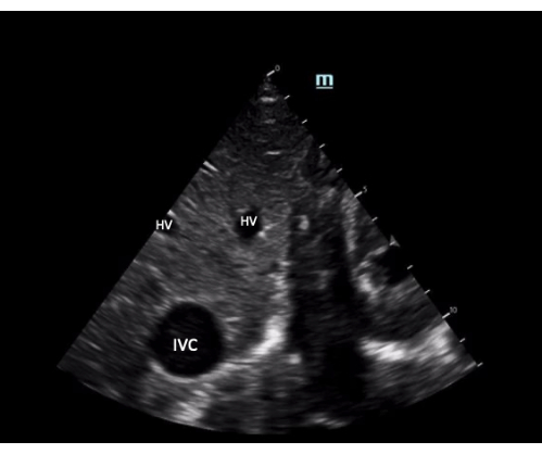Ultrasound showing hepatic veins (HV) and inferior vena cava (IVC) in abdominal imaging analysis.