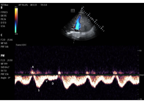 Cardiac ultrasound Doppler graph showing blood flow velocity analysis in heart chambers.