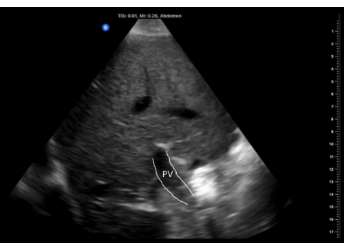 Ultrasound image of abdomen showing portal vein (PV) for diagnostic assessment.