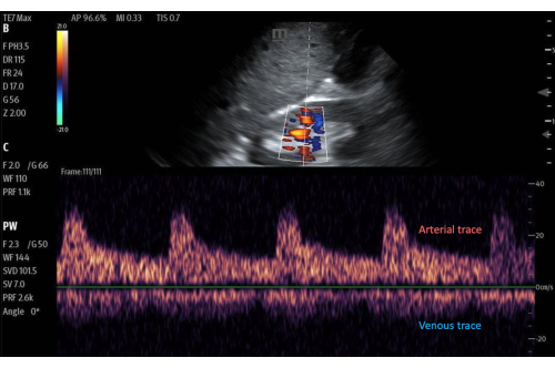 Cardiac ultrasound Doppler scan; velocity profile; arterial and venous flow; heart function analysis.