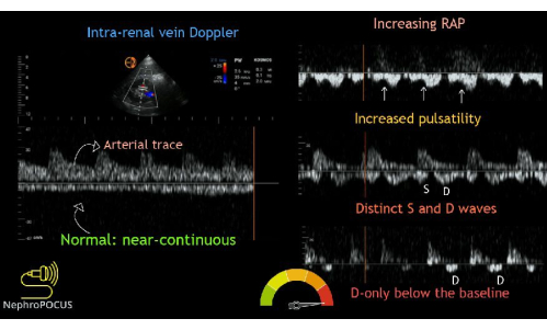 Intra-renal vein Doppler diagram, shows RAP, pulsatility, S and D waves analysis.