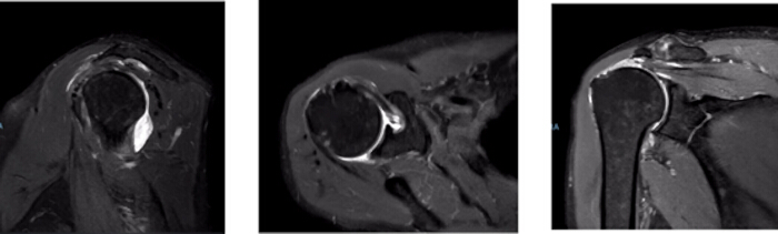figure-results-1 MRI shoulder scans; diagnostic imaging; joint evaluation; soft tissue assessment; medical analysis.