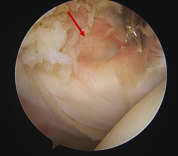 figure-results-2 Arthroscopic knee examination showing tissue structure; red arrow indicating area of interest.