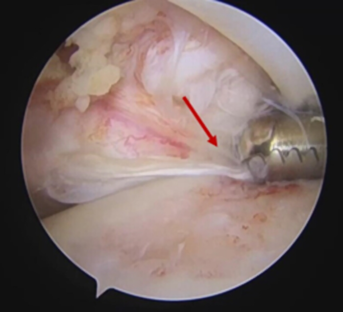 figure-results-3 Arthroscopic knee surgery diagram, highlighting tissue repair with medical instrument.
