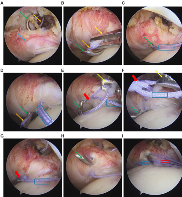 figure-results-4 Arthroscopic shoulder surgery procedure, steps A-I, illustrating suture anchor placement and tissue repair.
