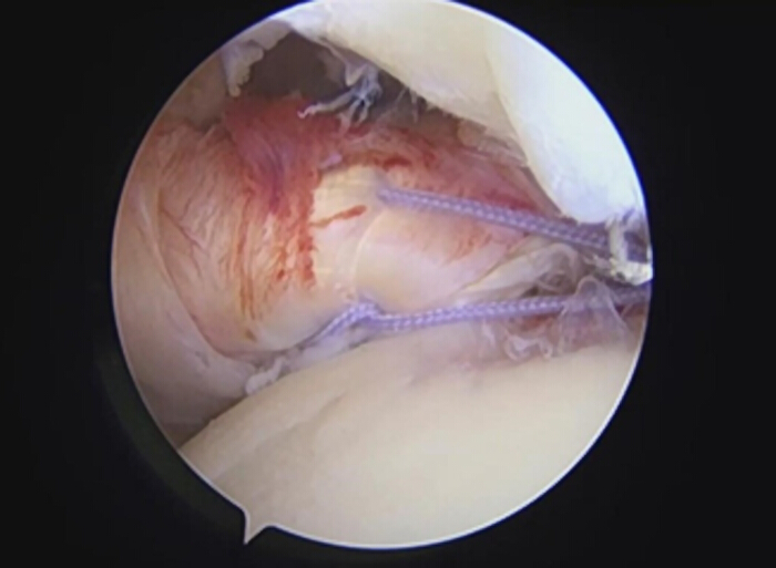 figure-results-5 Knee arthroscopy image showing ACL repair with sutures, surgical procedure, joint examination.