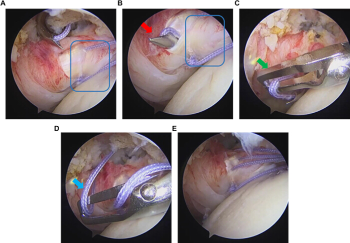 figure-results-6 Arthroscopy surgical technique showing tendon repair with suture in shoulder, step-by-step process.