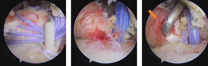 figure-results-7 Arthroscopic shoulder surgery process, detailed rotator cuff repair, medical procedure images.