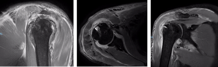 figure-results-8 MRI of shoulder joint anatomy; sagittal, axial, coronal views; musculoskeletal imaging.