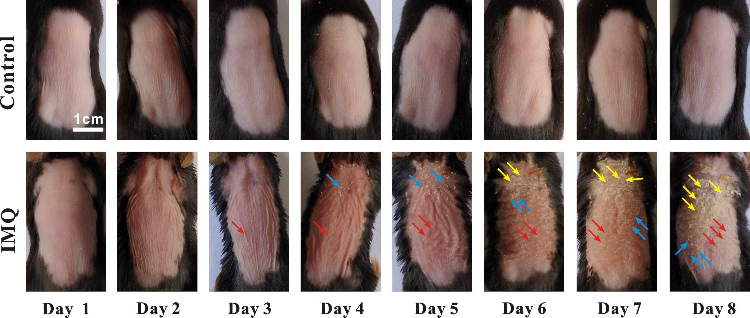 Establishment of Psoriasis Mouse Model by Imiquimod