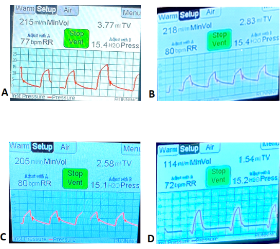figure-results-5 Ventilator settings graphs: respiratory rate, tidal volume, pressure in a medical display analysis.