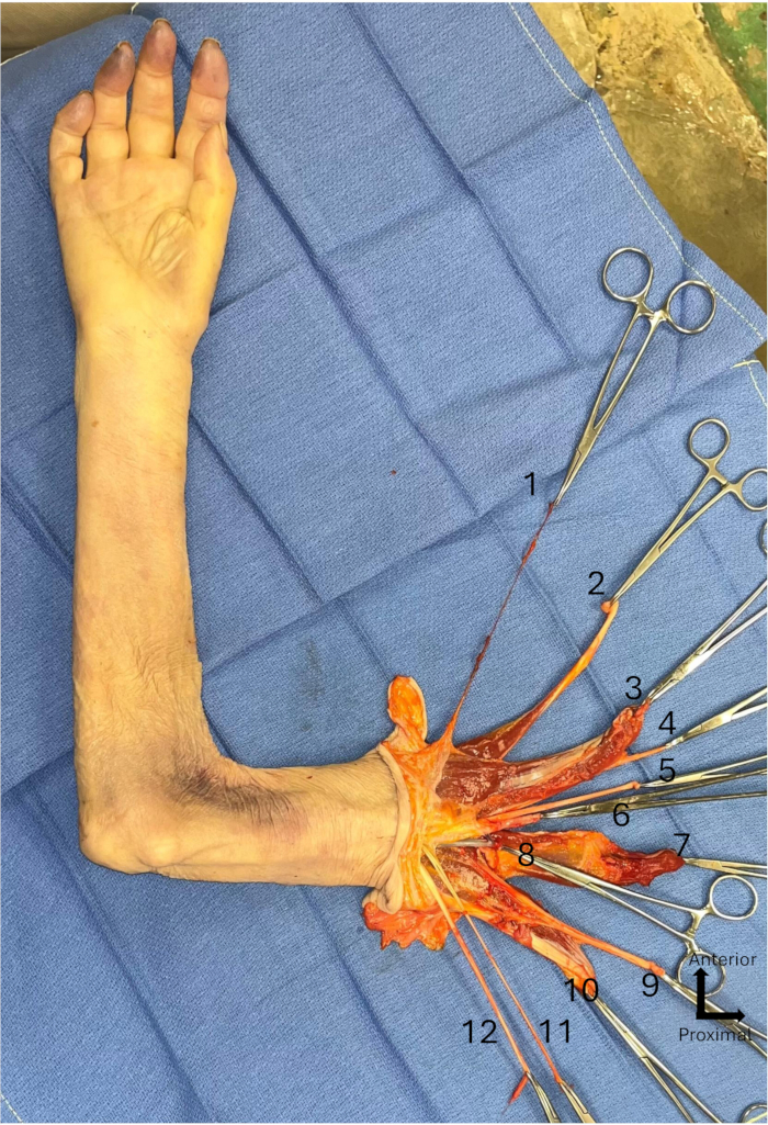 figure-protocol-1 Anatomical dissection diagram of human arm, showing nerve pathways with surgical tools.