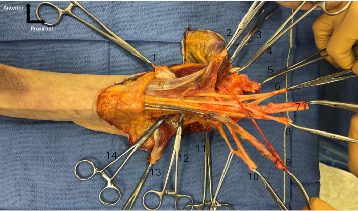 figure-protocol-3 Surgical dissection of human forearm tendons, highlighting anatomy with numbered forceps placement.